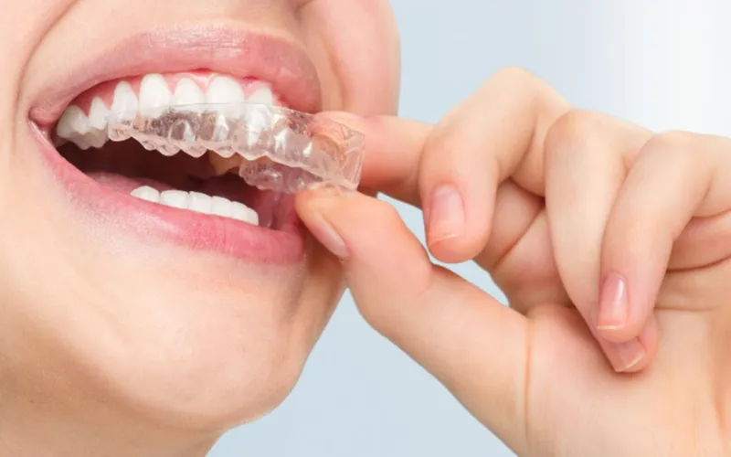 Best Invisalign Treatment in Ulwe | Invisible Braces at UR Dentist