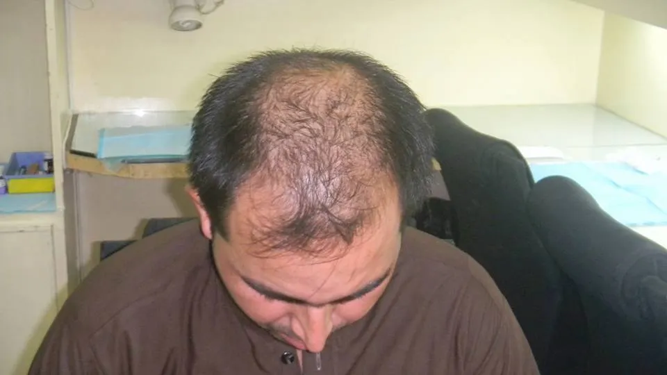 Is Hair Transplant in Lahore Worth It for Young Professionals Facing Stress‑Related Hair Fall?