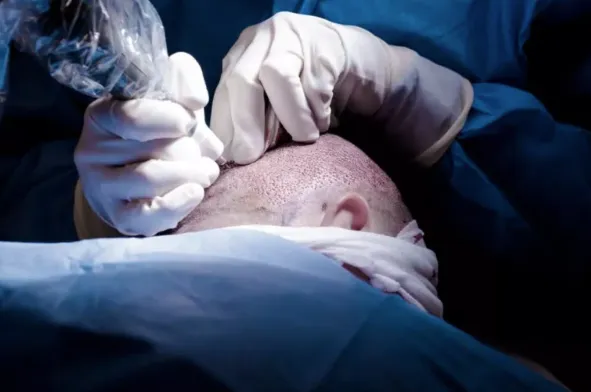 Hair Transplant Clinic HIV Positive: Understanding Safe Hair Restoration Options