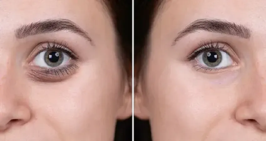 Top-Tier Eye Bag Removal in Dubai: A Patient's Roadmap