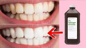 5 Reasons to Schedule a Dentist Appointment for Teeth Whitening San Diego