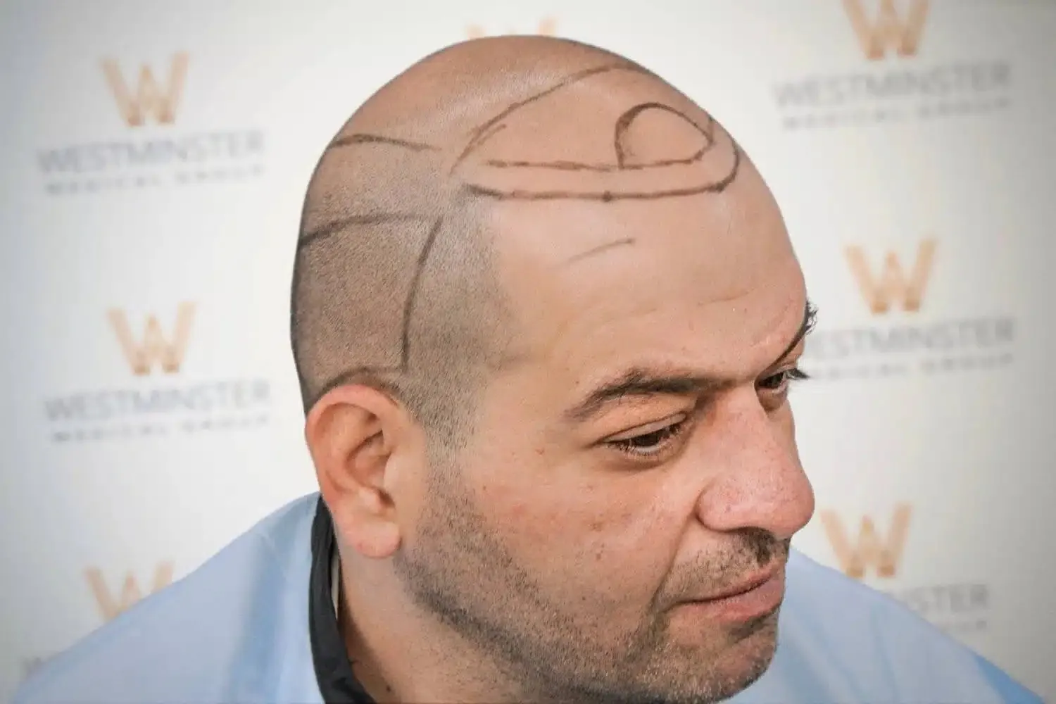 Hair Transplant Near Me for Men: Understanding Modern Restoration Solutions