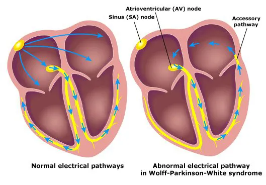 What Should You Know About WPW Syndrome Treatment for a Healthy Heart Rhythm?