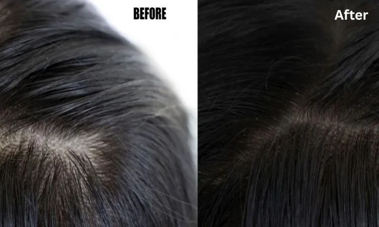 Hair Loss Treatment Dermatologist NYC: Expert Care with Dr. Dele-Michael