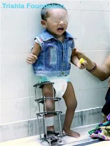 How Hemiplegic Cerebral Palsy Differs from Other Types of CP