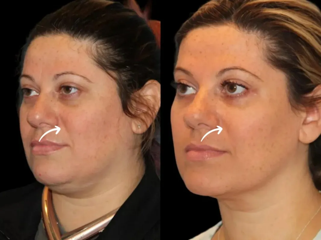 Sculptra Treatments in Dubai for Empty Facial Spaces