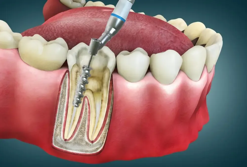 Can You Avoid Root Canal Treatment? Prevention Tips from Dentists