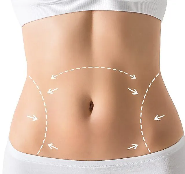 BodyTite Liposuction: The Advanced Approach to Body Sculpting