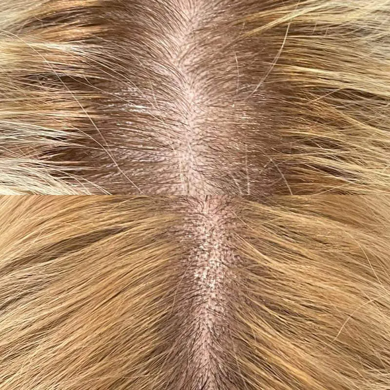 Pot​ential Risks and Side Effect​s Associated⁠ with Ha⁠ir Transpla⁠nts
