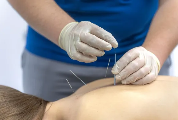 Dry Needling Veenendaal Ede bij Spierklachten