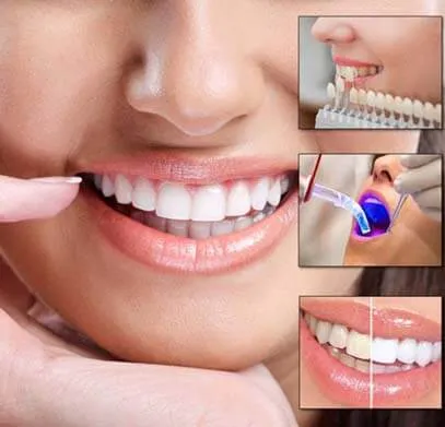 How Long Do Porcelain Veneers Actually Last Before They Need Replacing?