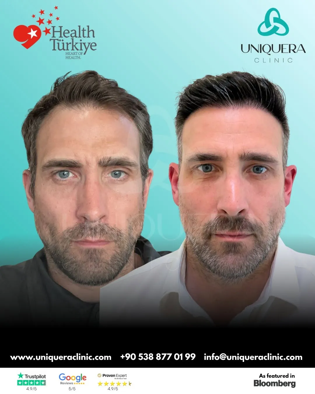 Is Manual Hair Transplantation Right for Your Hair Loss Needs?