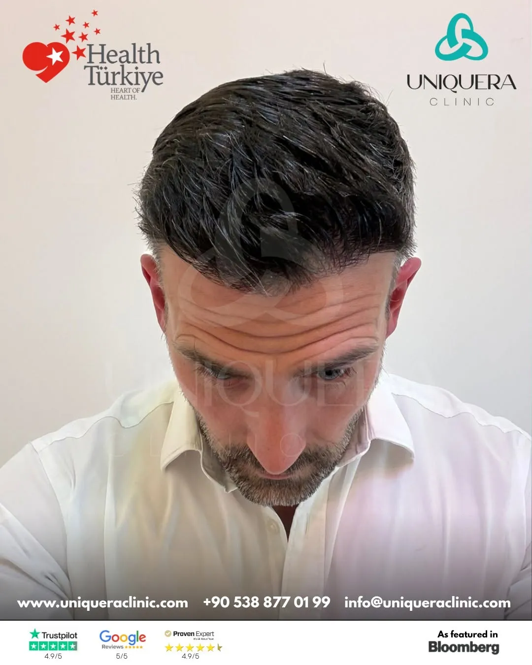 Sapphire FUE vs DHI Hair Transplant Surgery in Turkey