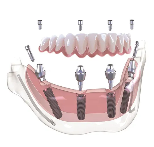 All On 4 Dental Implants San Diego: A Complete Guide from a San Diego CA Dentist