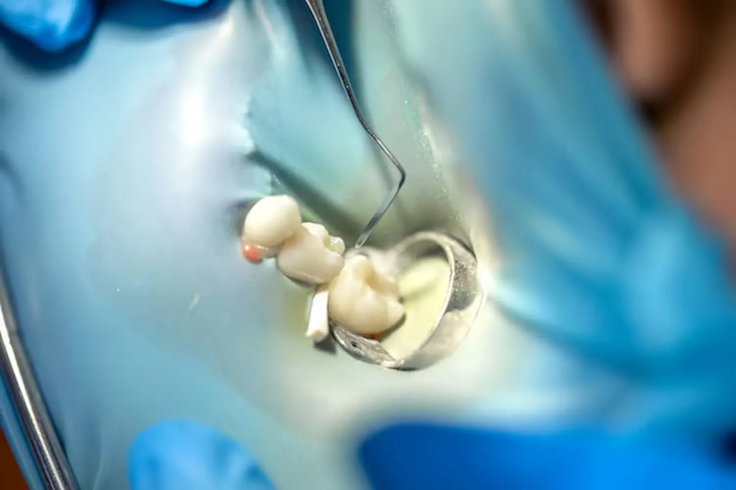 What to Know Before Getting Dental Crowns Sherman Oaks