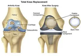 Understanding the Cost of Knee Replacement Privately What You Need to Know