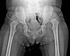 When Surgery is Needed for Congenital Hip Dislocation Treatment?