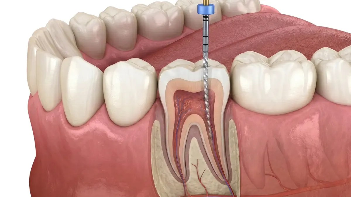 Root Canal Treatment in Toronto: Save Your Natural Tooth and Relieve Pain