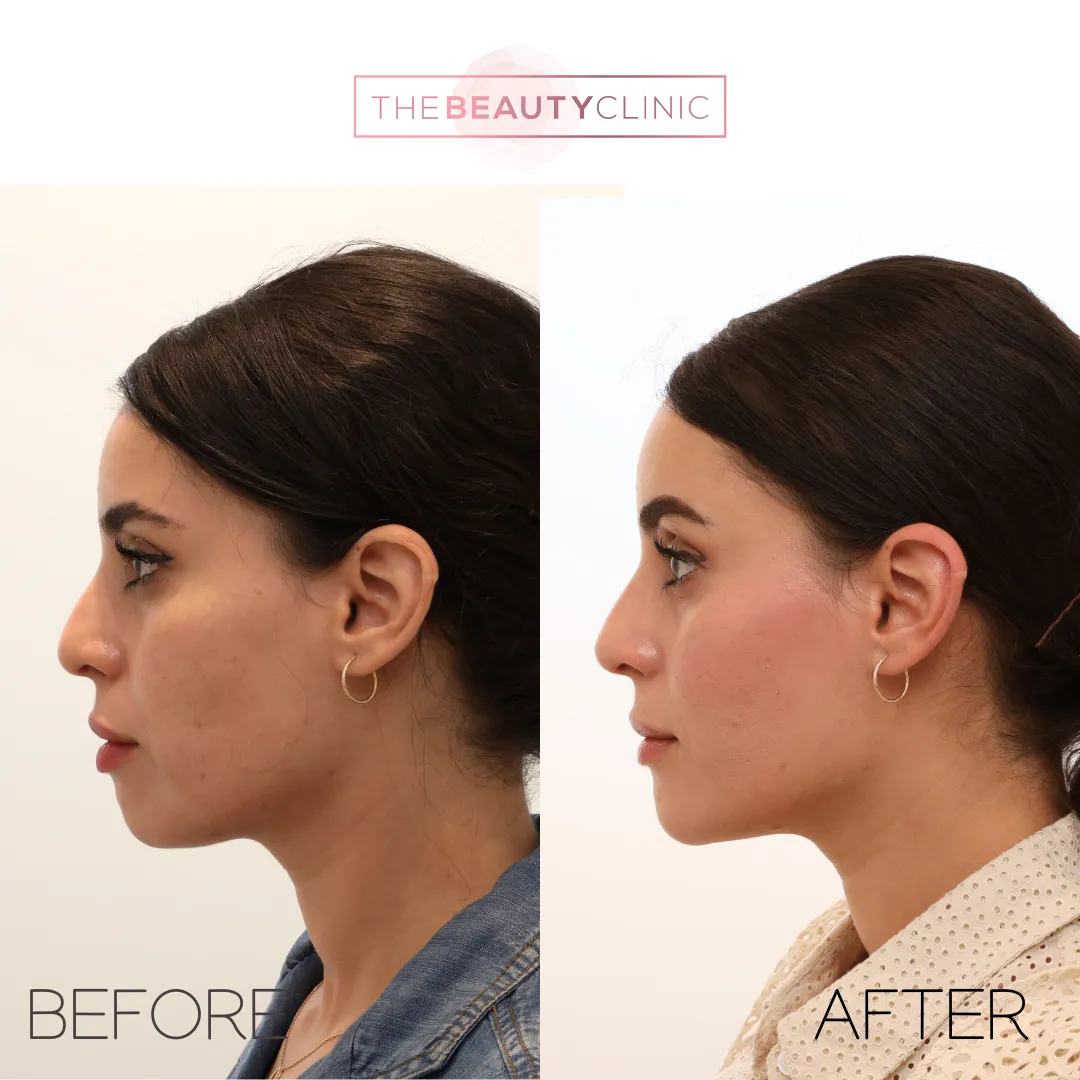How PRF EZ Gel Enhances Facial Rejuvenation
