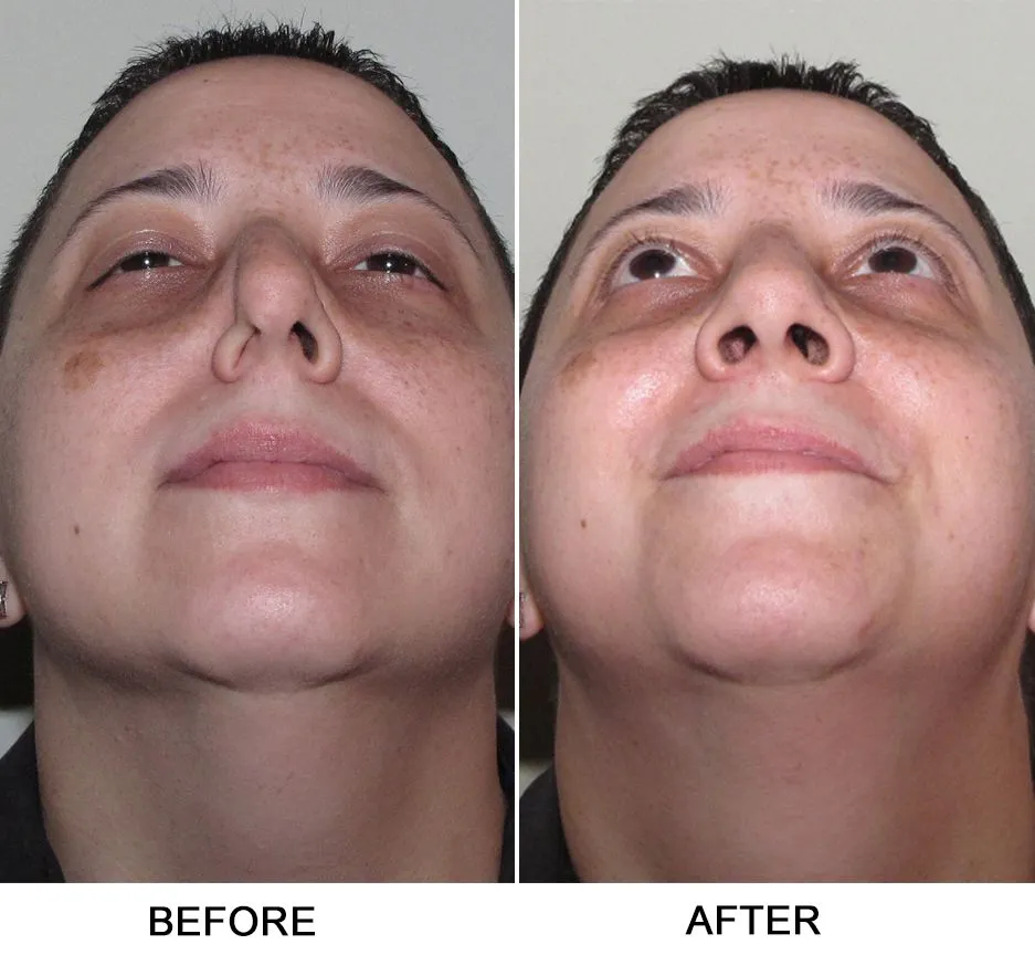 Septoplasty and Turbinate Reduction in Dubai: Nasal Health