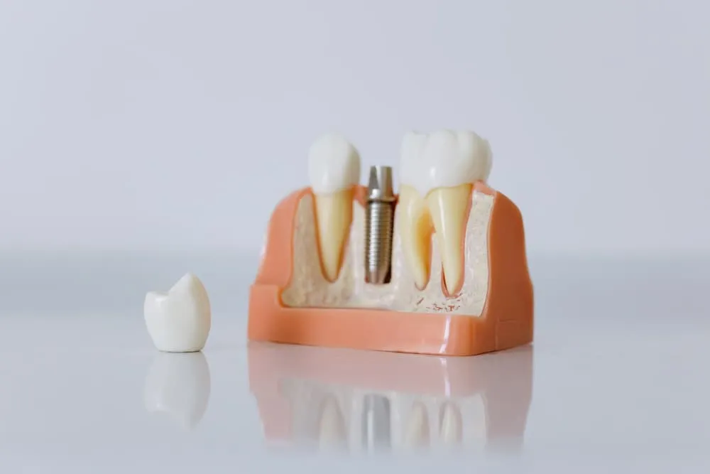 Recovery Tips After Getting Dental Implants