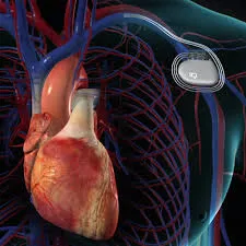 How Can a Pacemaker of the Heart Improve Everyday Life for Cardiac Patients?