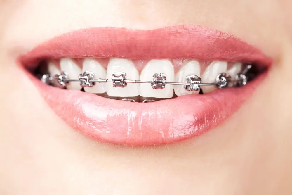 Ultimate Guide to Adult Braces: Challenges and Solutions