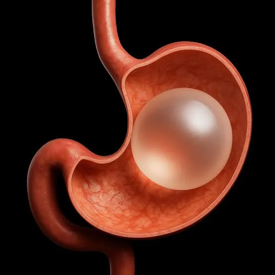 Top Facts About Gastric Balloon Placement for Patients