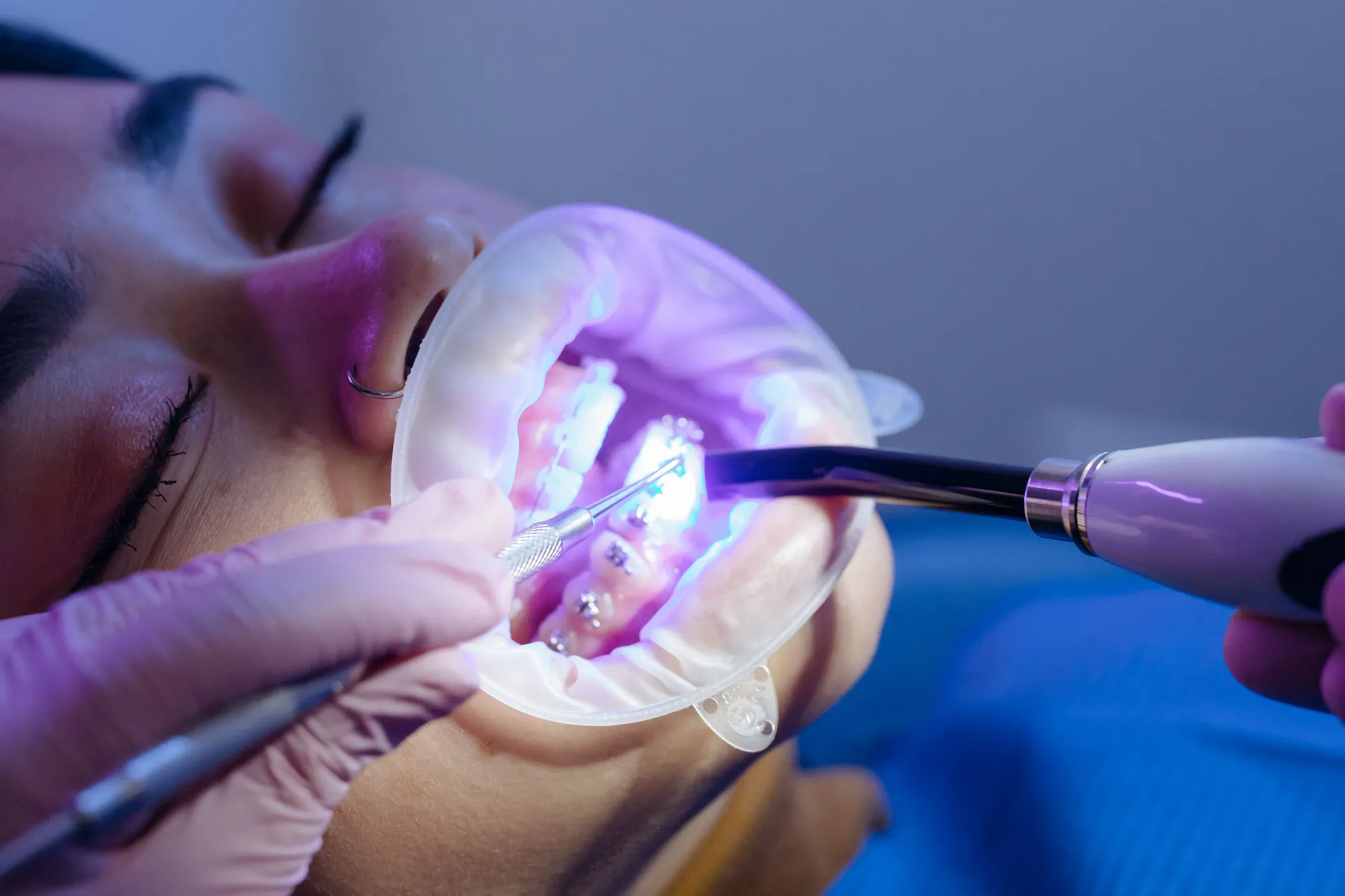 How Professional Whitening Improves Smile Confidence