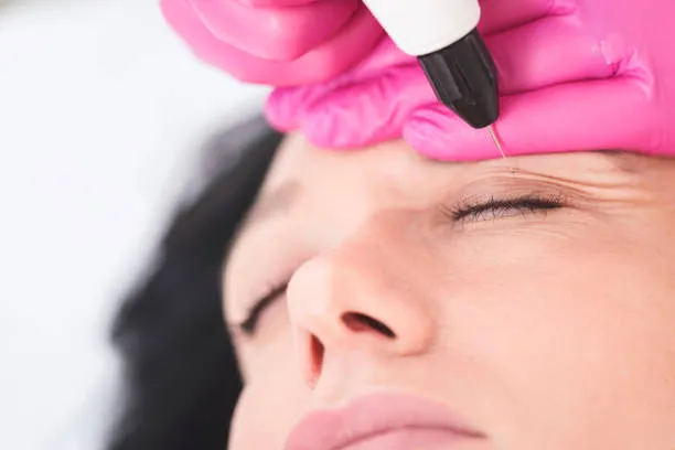 Droopy Eyelid Surgery London: Causes, Treatment and Recovery
