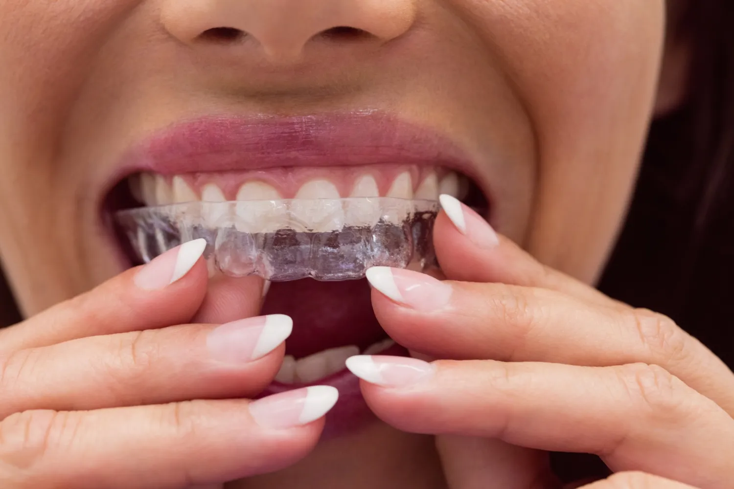 Protecting Your Smile With Invisalign Retention Solutions
