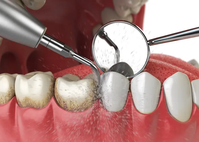 Benefits of Professional Teeth Cleaning Beyond a Brighter Smile