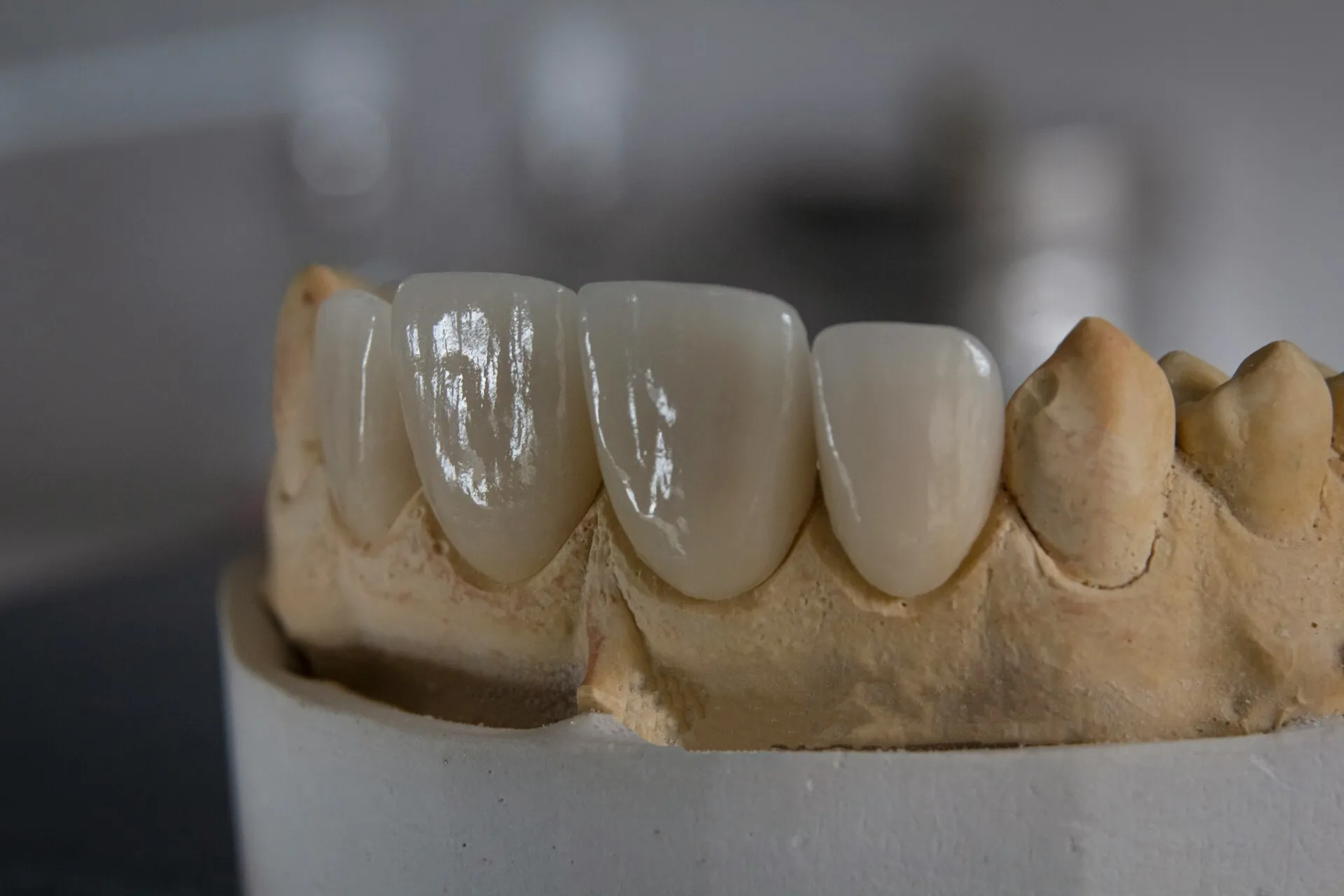 Restore Your Smile With Durable Dental Crowns Oxnard Treatment Options