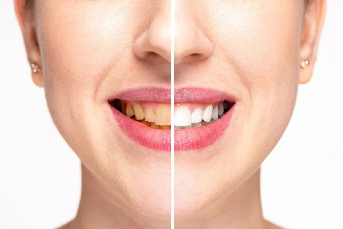 How Professional Teeth Whitening Differs from At-Home Kits