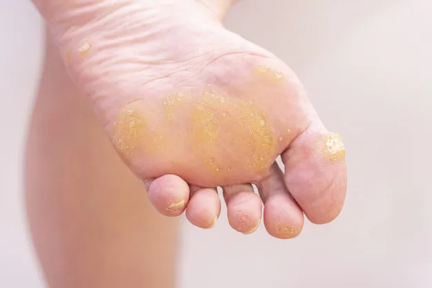How Long Does It Take a Podiatrist to Remove a Wart?