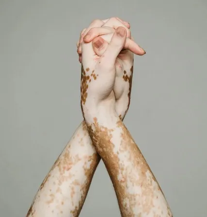 How Does Vitiligo Occur?