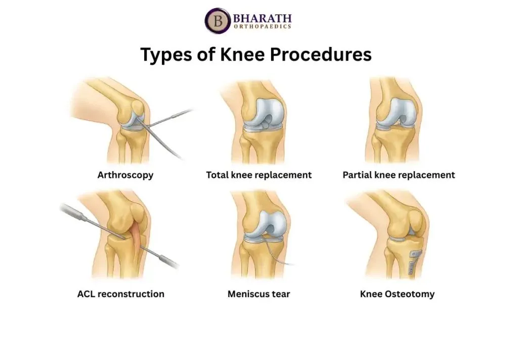 Knee Procedures in Chennai: Advanced Solutions for Pain Relief