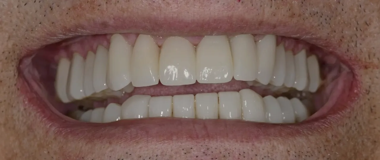 Full Mouth Rehabilitation Cost in Hubli | Vishwa Vande Dental