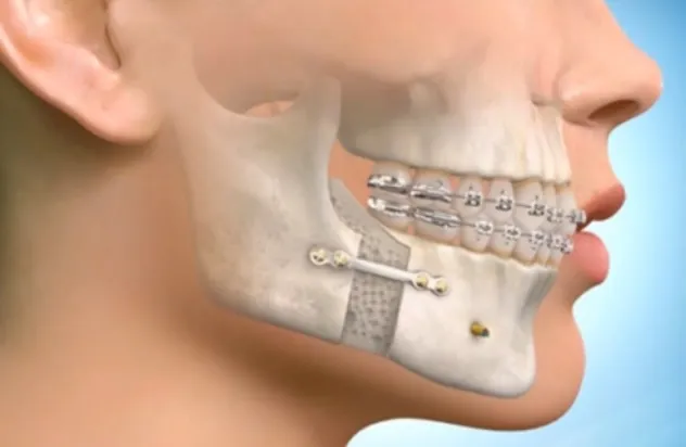 Achieve Balanced Facial Features with Jaw Surgery  at Glam Aesthetic Clinic