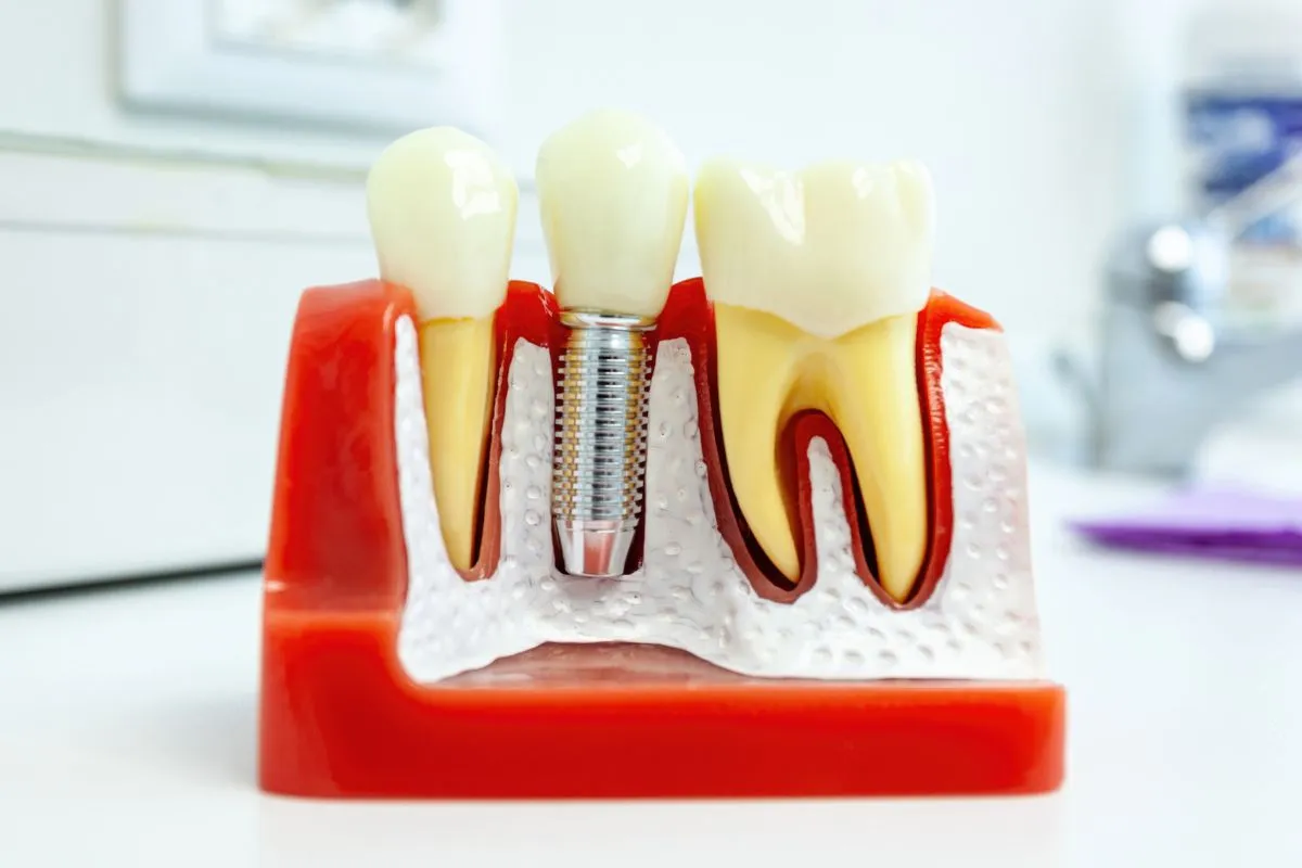 How Long Do Dental Implant Restorations Last? A Newport News Patient Guide