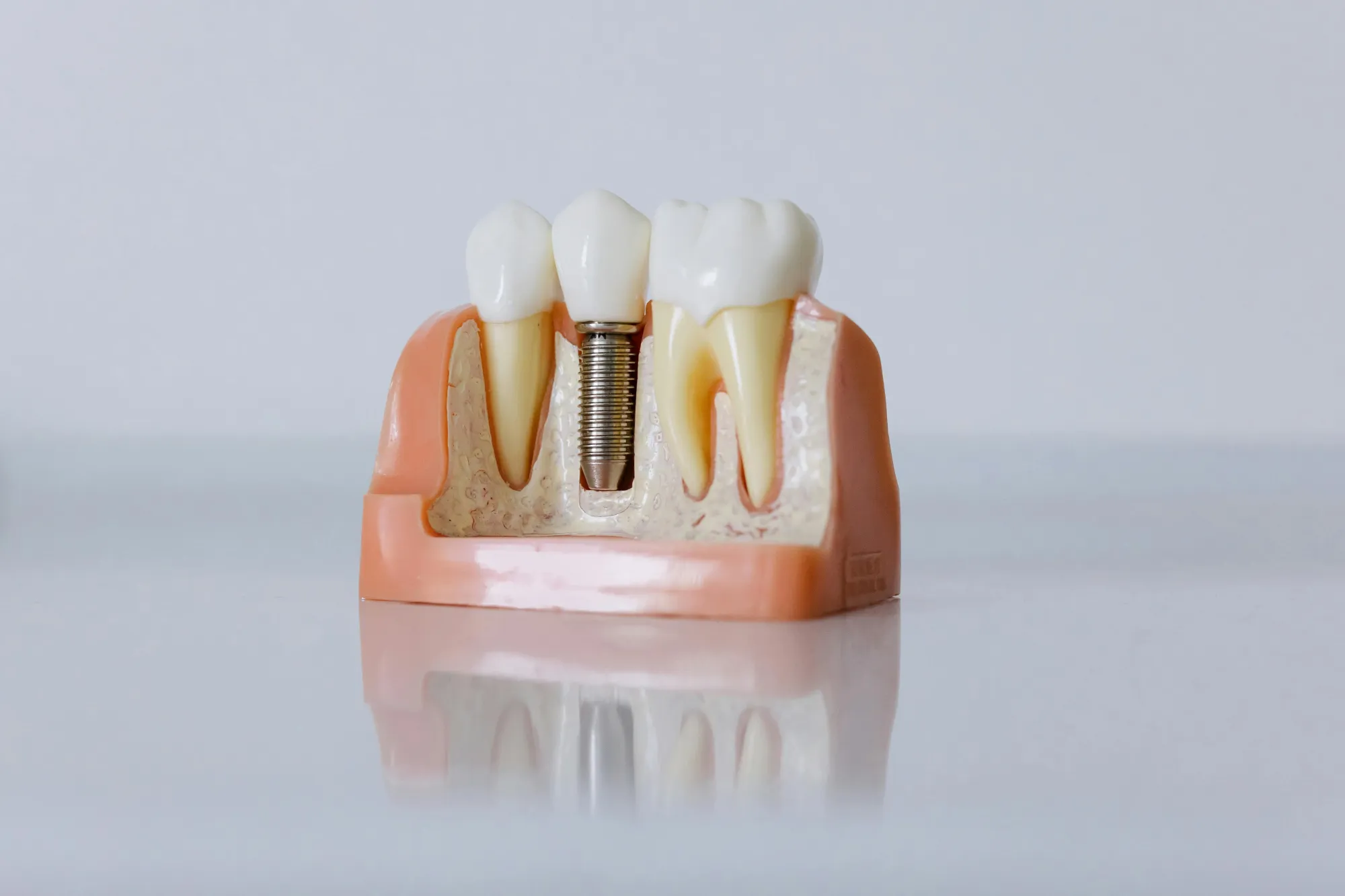 Why Dental Implants Turkey Attract International Patients