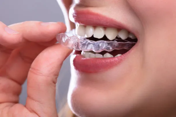 Straightening You Smile with Modern Orthodontic Treatments