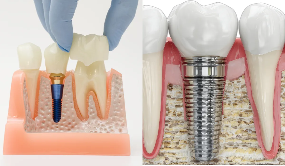 7 Reasons to Choose Dental Implants Treatment in Lahore – Book an Appointment