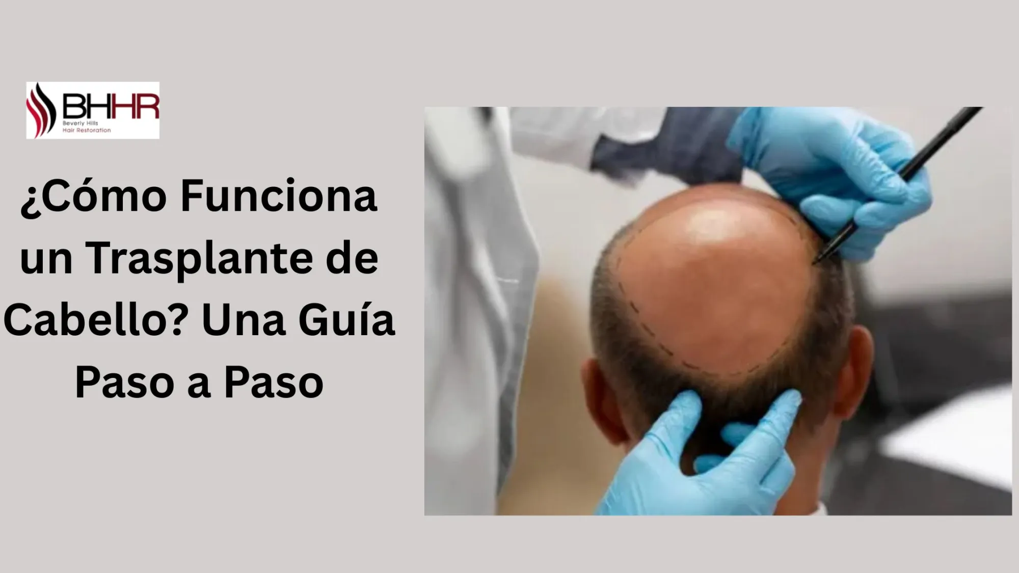 ¿Cómo Funciona un Trasplante de Cabello? Una Guía Paso a Paso