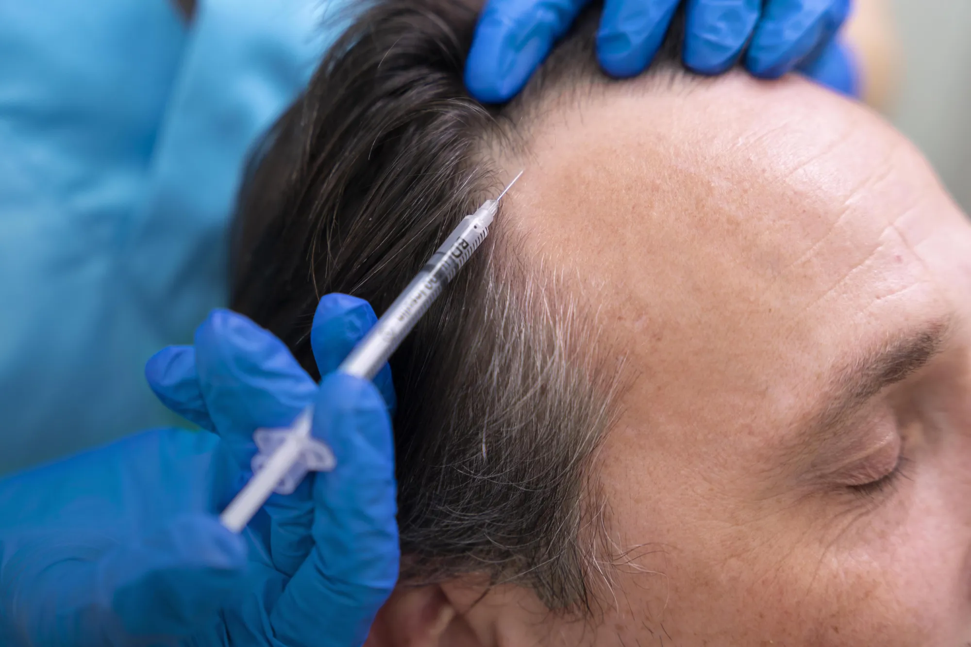 PRF Hair Treatment: A Natural Approach to Hair Restoration