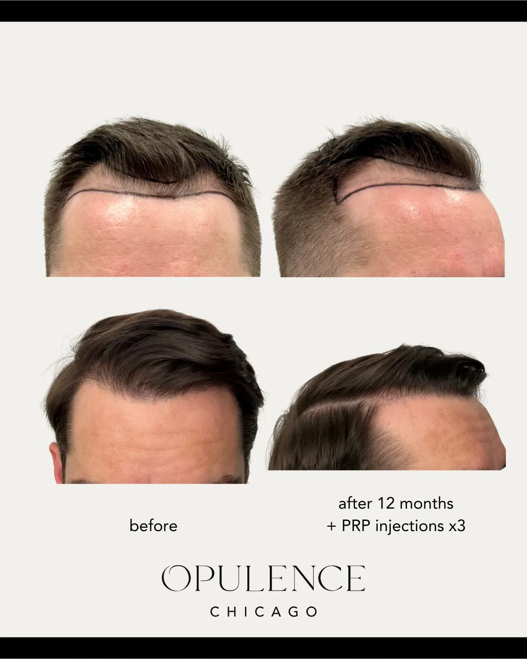 Hair Loss Solutions Chicago: Effective Hair Restoration Treatments for Fuller, Healthier Hair