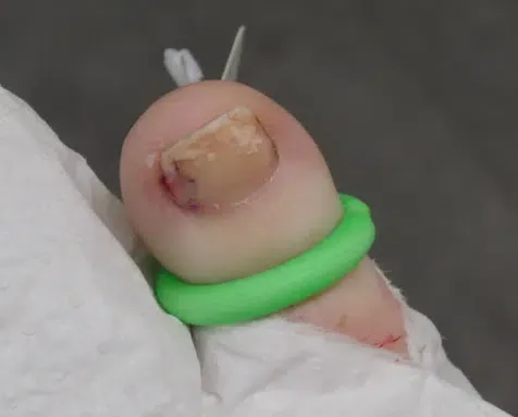 What Is the Fastest Way to Cure Nail Fungus?