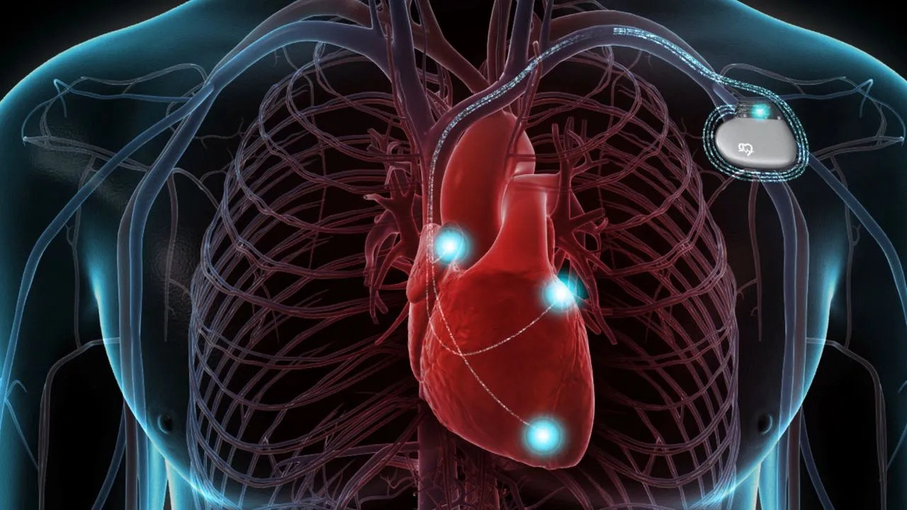 Why Is ICD Implant Surgery Important for Managing Serious Heart Rhythm Disorders?