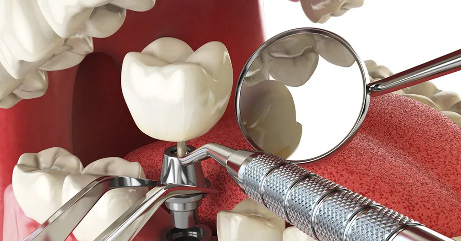 Why Dental Implants Are the Preferred Solution for Missing Teeth