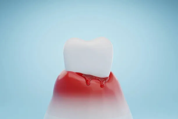 Bleeding Gums Every Time You Brush? Here's What It Could Mean